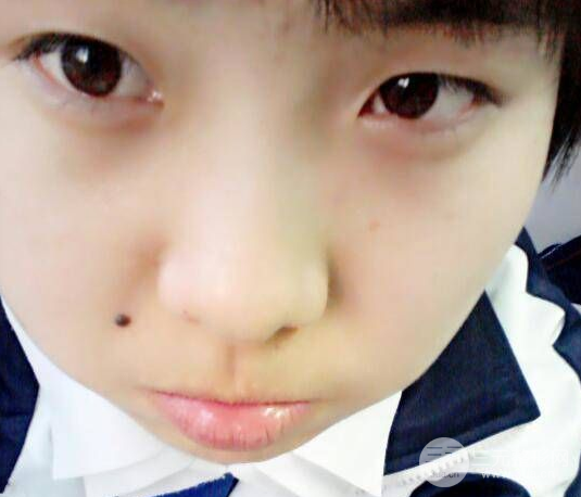 刘风卓眼修复技术怎么样双眼皮修复案例发布