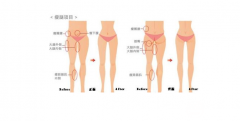 小腿吸脂减肥讲解，有没有副作用，看看就知道！