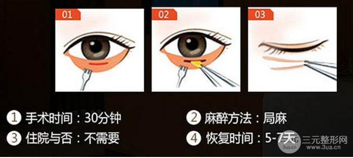 去眼袋整形手术