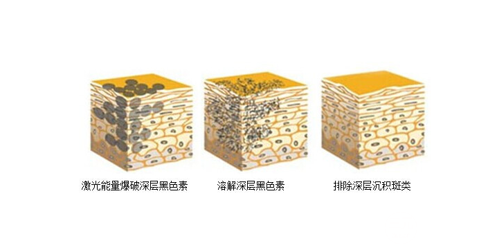 e光祛斑要多少钱