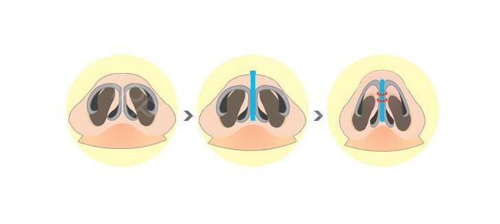 鼻头缩小术过程图