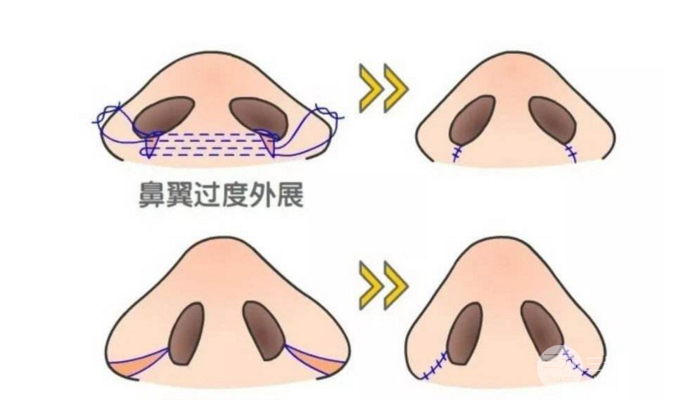 鼻头缩小术过程图