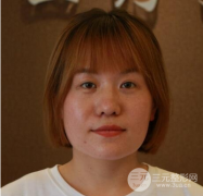 面部溶脂前后对比高清照片，小V脸轻松拥有！