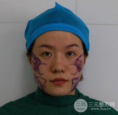 面部溶脂前后对比照片