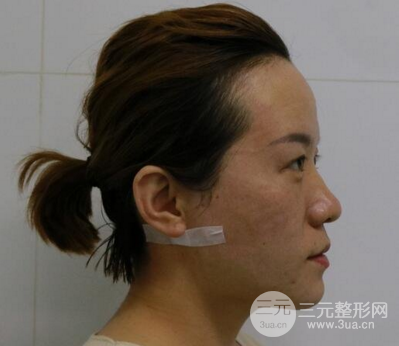 面部溶脂前后对比照片