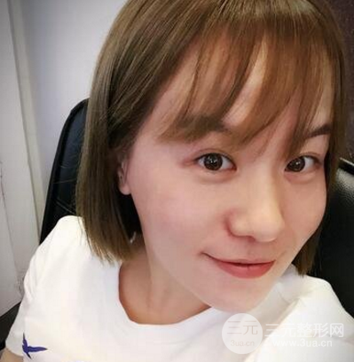 面部溶脂前后对比照片