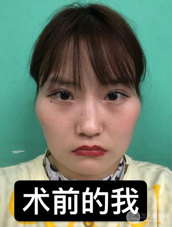 杨君毅磨骨怎么样颧骨消失后真的太温婉清纯了
