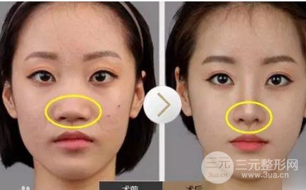 注射瘦脸注射缩鼻头