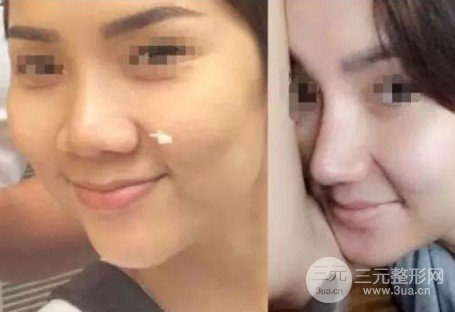 注射瘦脸注射缩鼻头