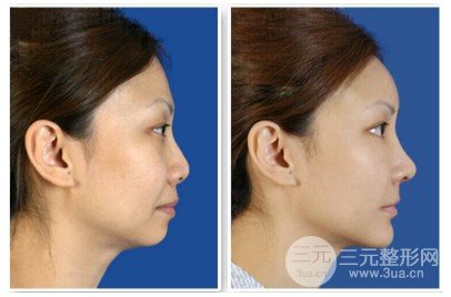 垫下巴前后对比图