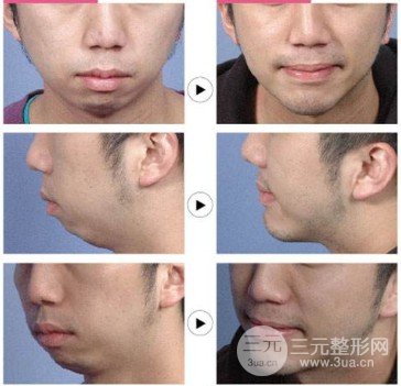 垫下巴前后对比图