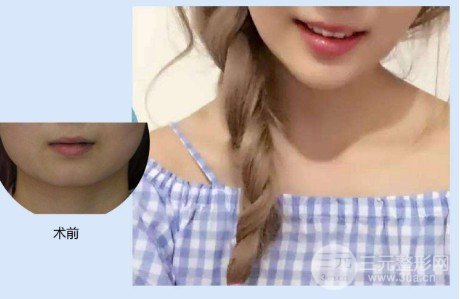 垫下巴前后对比图