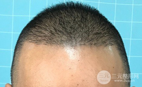 如何让发际线慢慢变低
