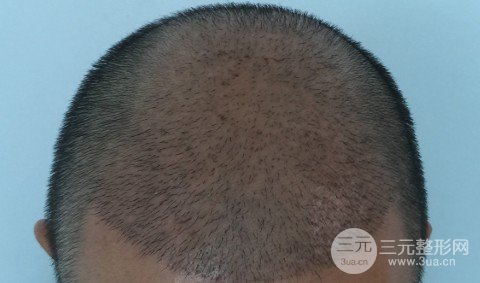 如何让发际线慢慢变低