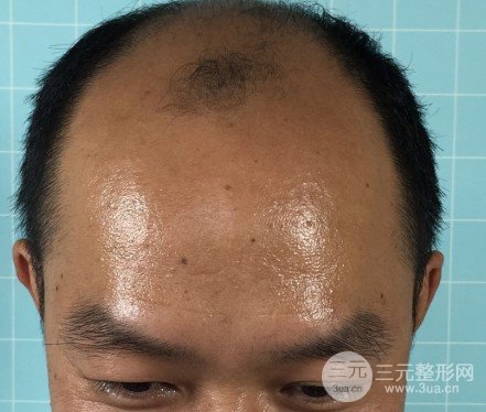 如何让发际线慢慢变低