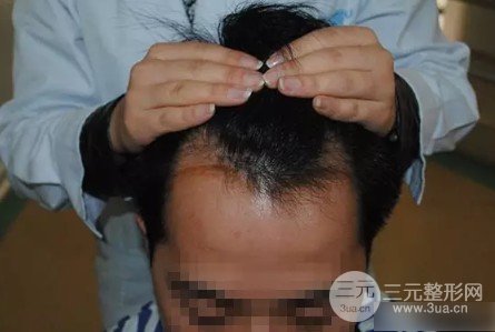 看下1000个毛囊面积图片植发际线够不够