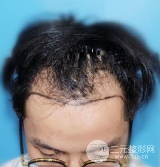 1000个毛囊面积图片