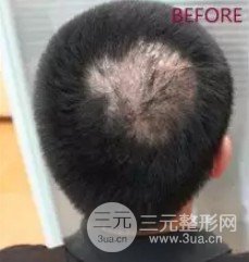 1000个毛囊面积图片
