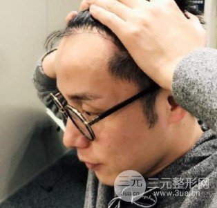 1000个毛囊面积图片