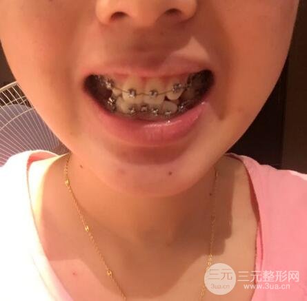 华西医院整牙案例