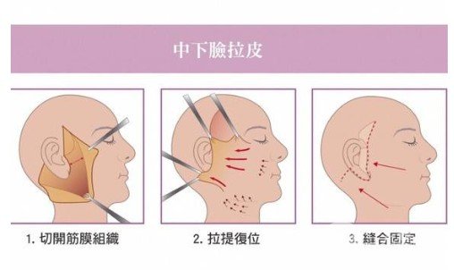 面部拉皮去皱整形方式介绍,保持及恢复时间要多久 面部拉皮去皱整形方式介绍,保持及恢复时间要多久