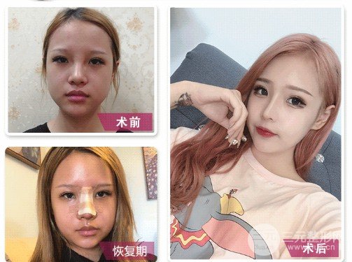 膨体隆鼻会变形吗