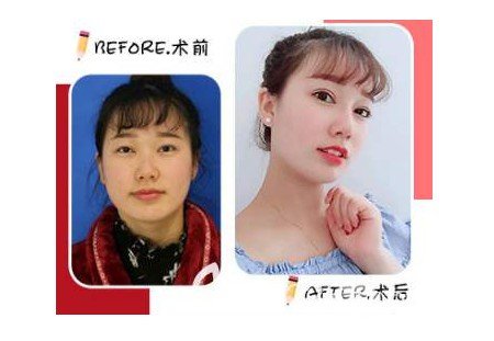 硅胶隆鼻的危害