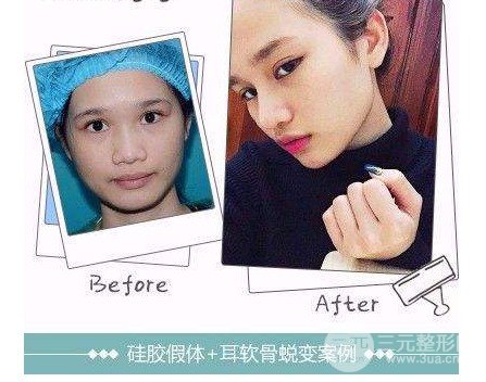 硅胶隆鼻的危害