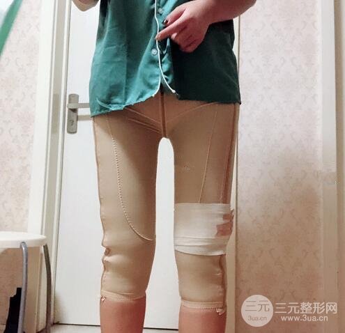 大腿吸脂