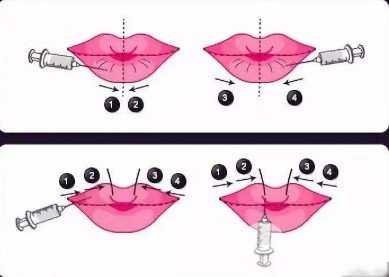 玻尿酸丰唇多少钱一针