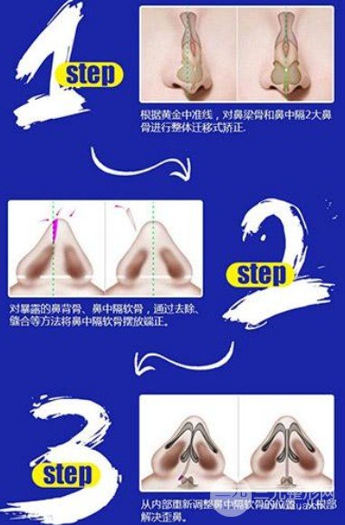 做歪鼻矫正鼻夹板需要戴多久