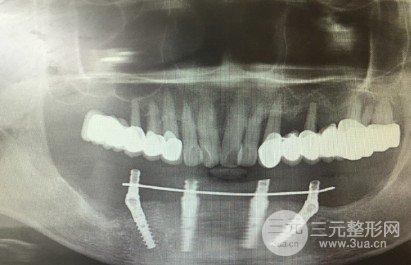 雅博士口腔医院牙齿种植案例