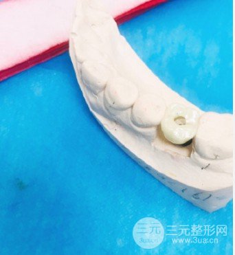 黄冈皓清口腔医院种植牙价格
