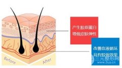 埋线面部除皱使用的什么材料?埋线越多果更好吗? 埋线面部除皱使用的什么材料?埋线越多果更好吗?