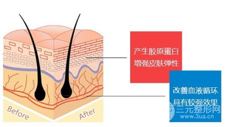埋线面部除皱使用的什么材料