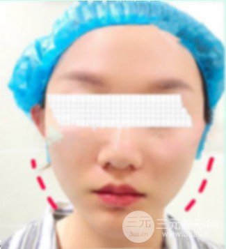 埋线面部除皱使用的什么材料