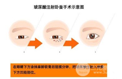 玻尿酸填充卧蚕
