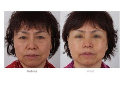 热玛吉除皱果多久