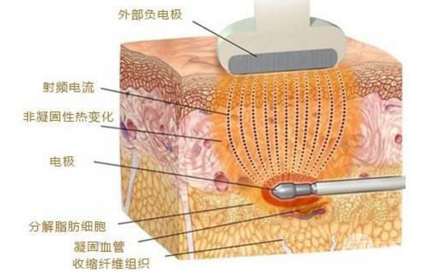 光纤腹部吸脂手术塑形的果好不好？
