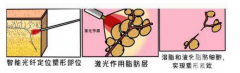 光纤腹部吸脂手术塑形的果好不好？