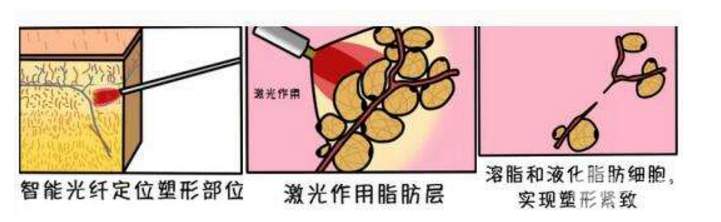 光纤腹部吸脂手术塑形的果好不好？