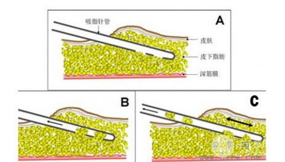 光纤腹部吸脂手术塑形的果好不好？
