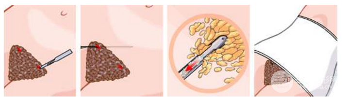 2019年腰部吸脂减肥价格一览表 附抽脂图