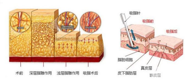 2019年腰部吸脂减肥价格一览表 附抽脂图
