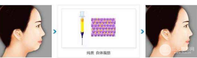 自体脂肪丰下巴