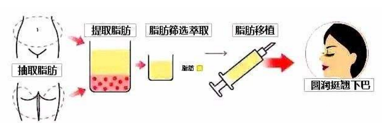 自体脂肪丰下巴