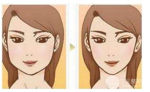 改脸型手术多少钱