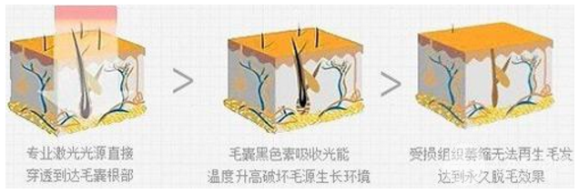 脸部激光脱毛要多少钱