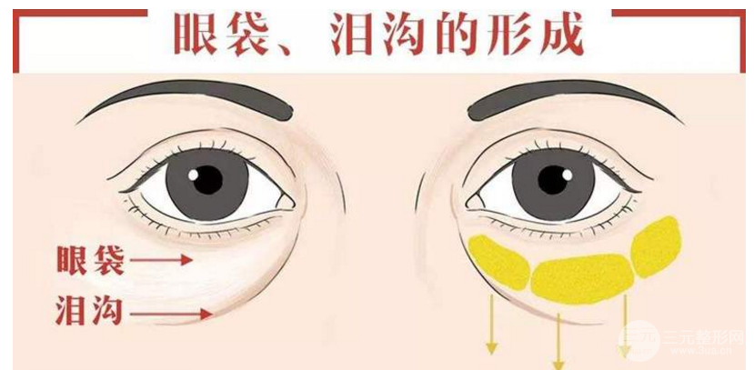 去眼袋大概价格