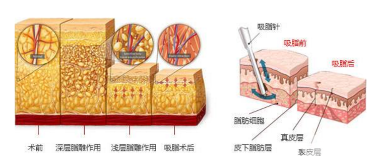 腿部吸脂减肥价格